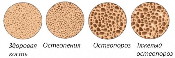 Этапы развития остеопороза